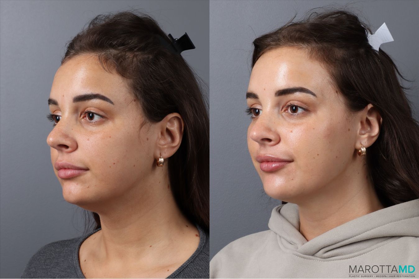 Before and after Botox - DAO case 41870 - Angle 4