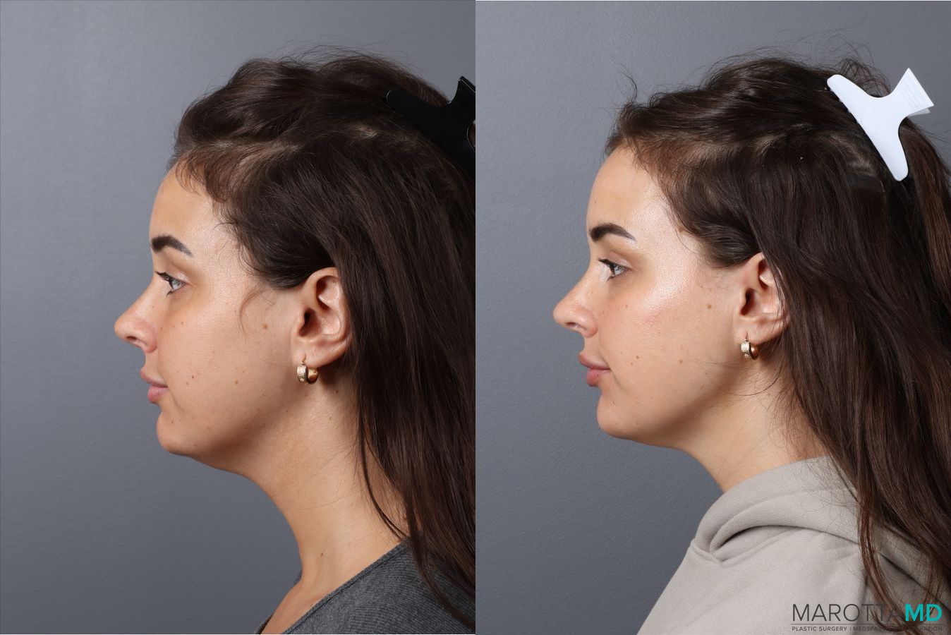 Before and after Botox - DAO case 41870 - Angle 5