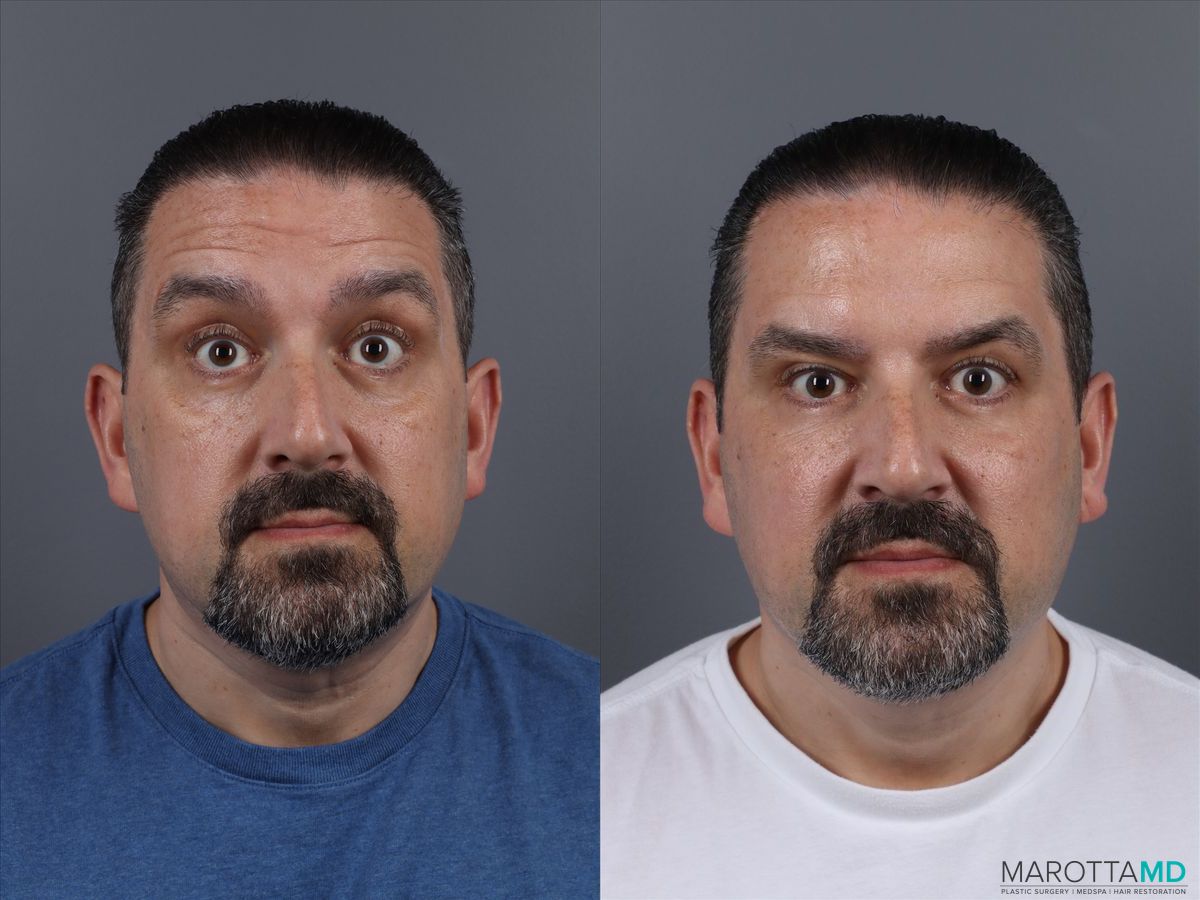 Before and after Botox - Forehead case 14120 - Angle 2
