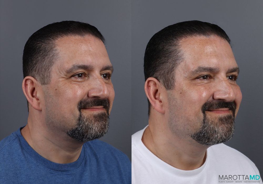 Botox - Glabella - Thumbnail 3