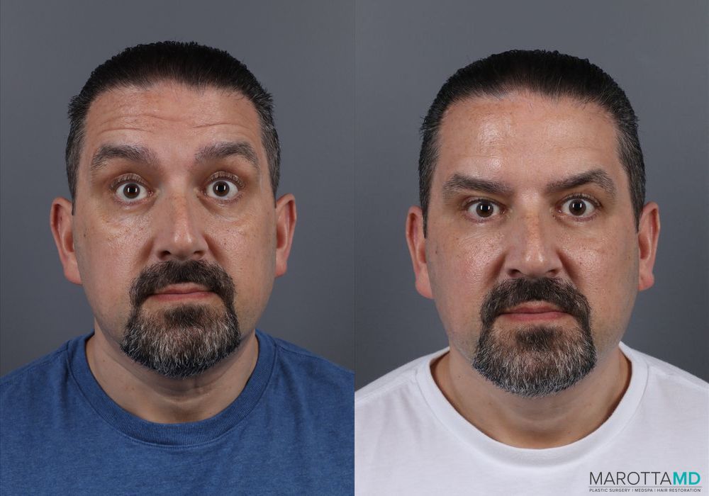 Botox - Glabella - Thumbnail 2