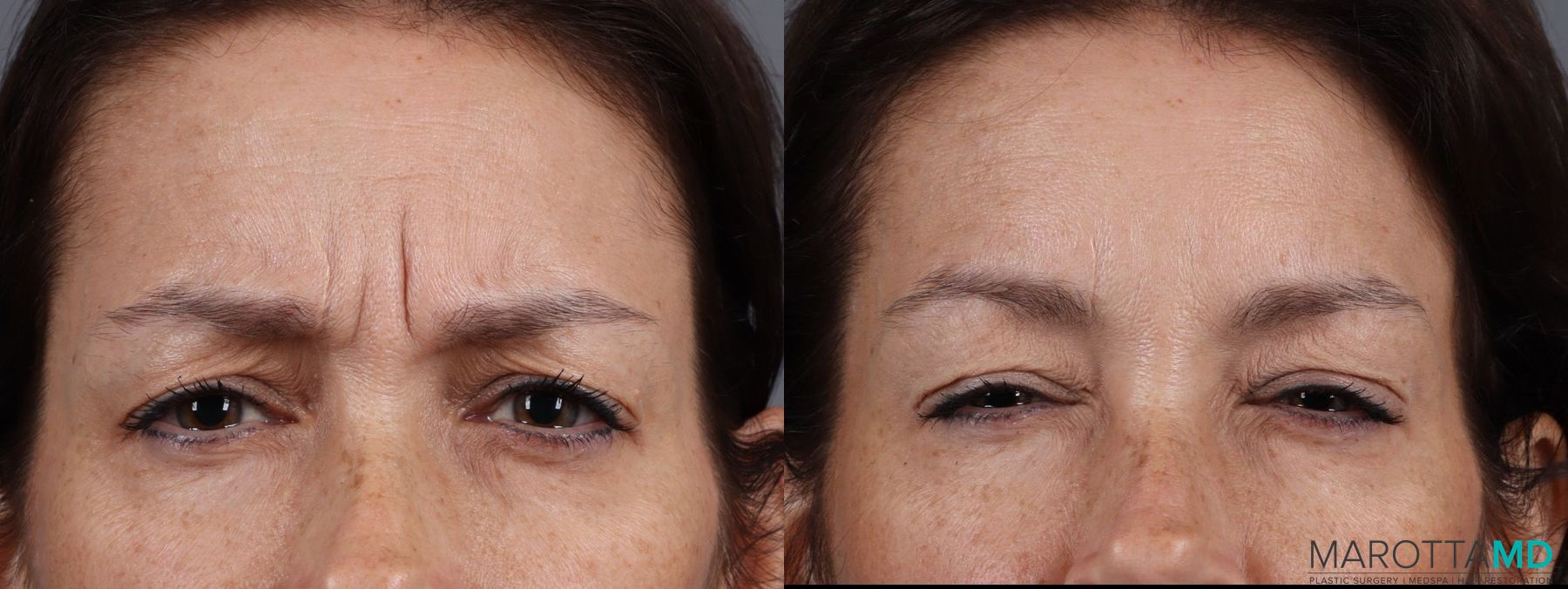 Before and after Botox - Forehead case 7180
