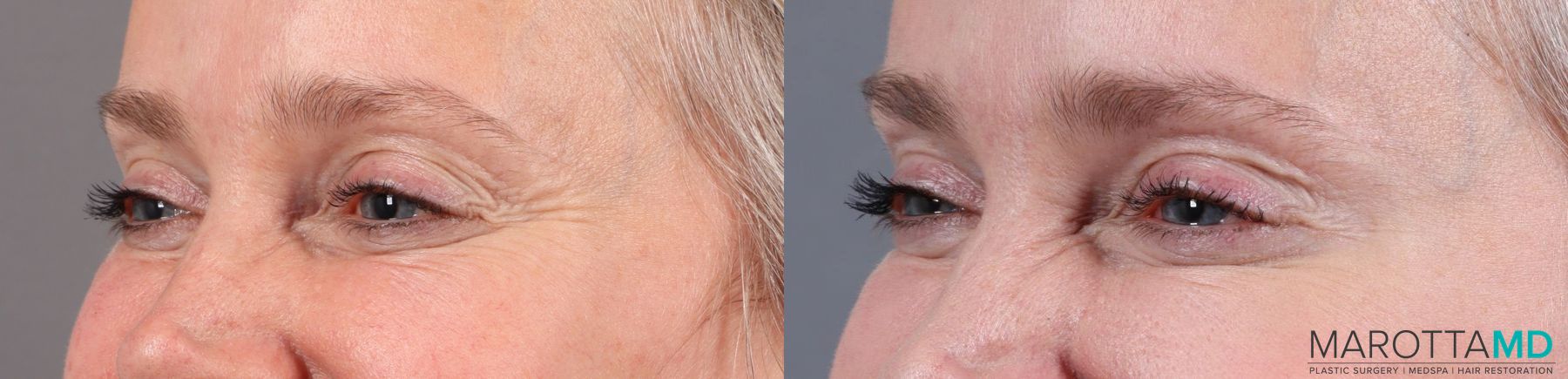 Before and after Botox - Forehead case 7170 - Angle 3