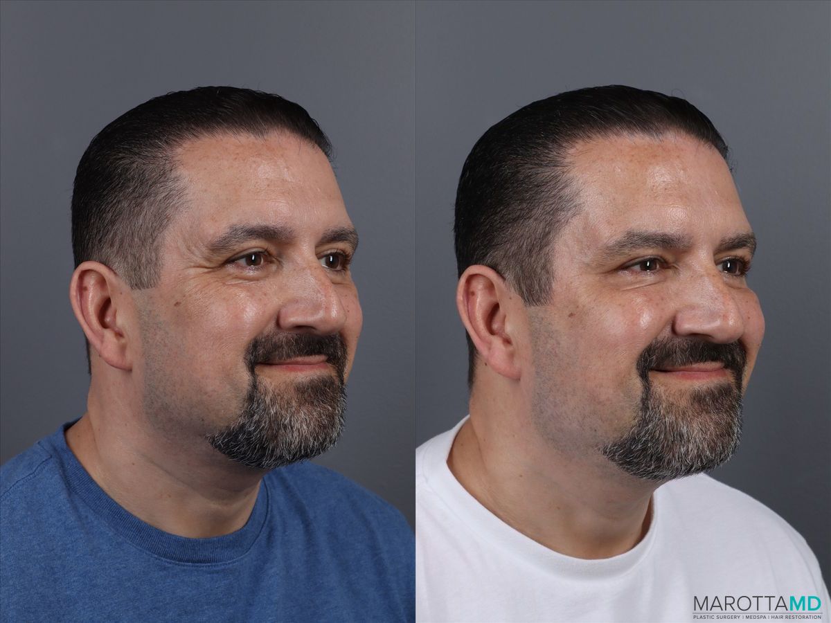 Before and after Botox - Forehead case 14120 - Angle 3