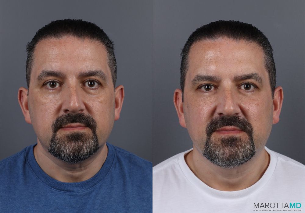 Botox - Glabella - Case 1179