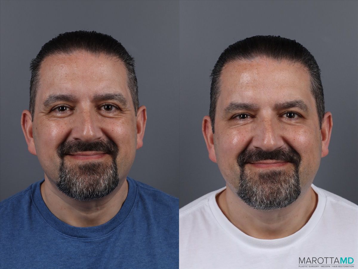 Before and after Botox - Forehead case 14120 - Angle 4