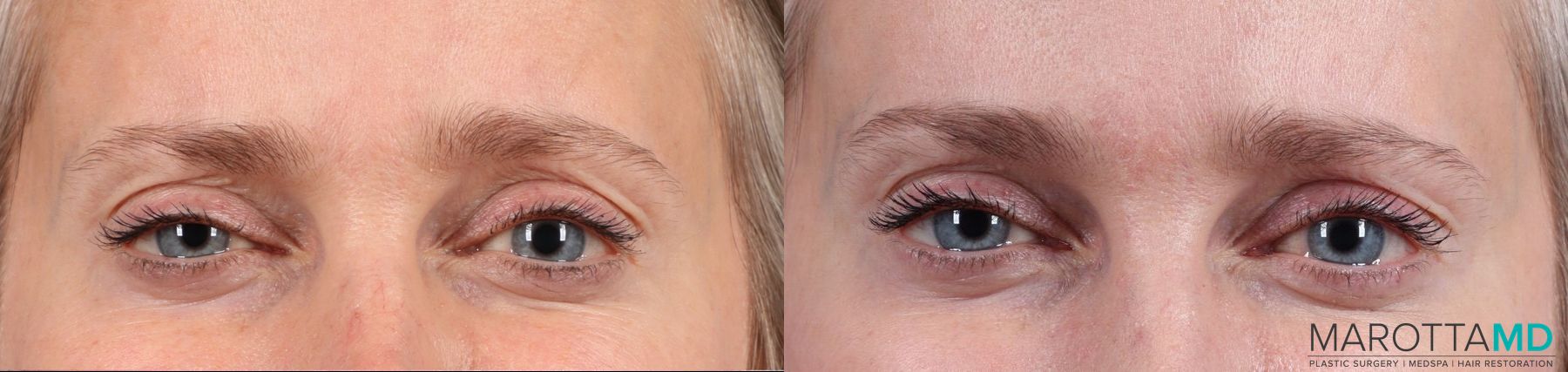 Before and after Botox - Forehead case 7170