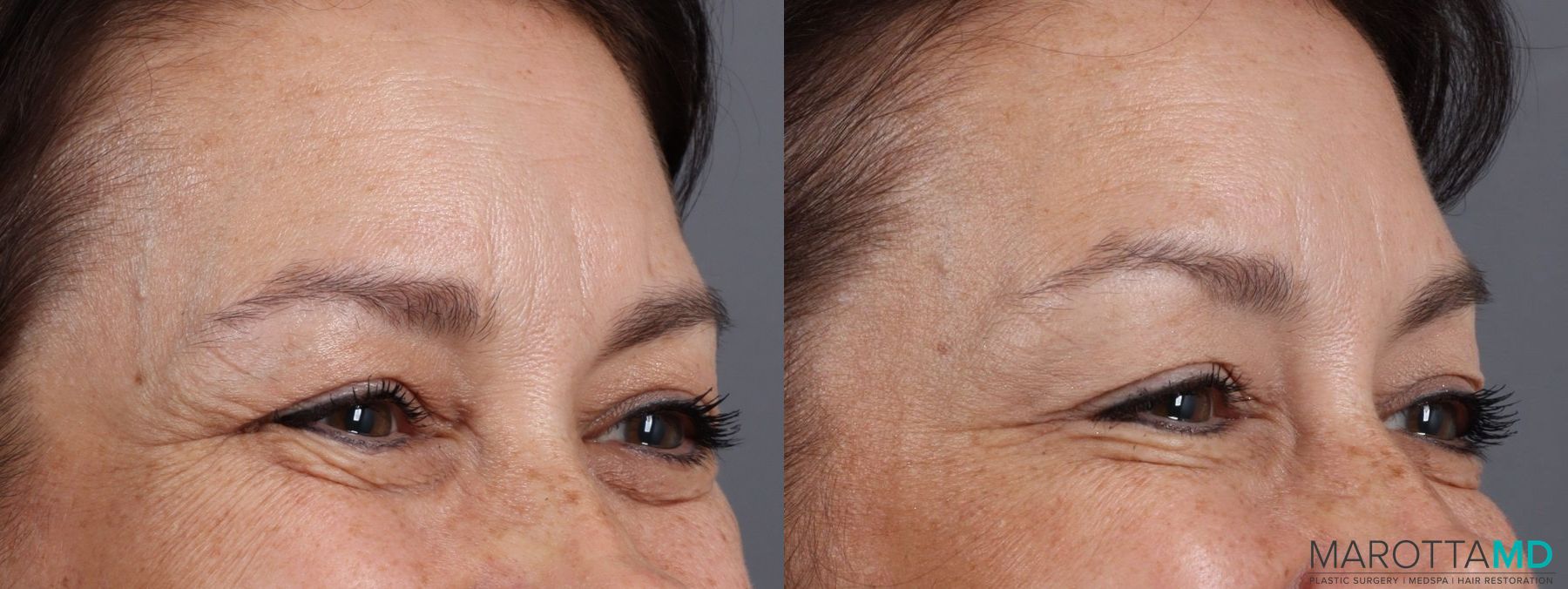 Before and after Botox - Forehead case 7180 - Angle 3