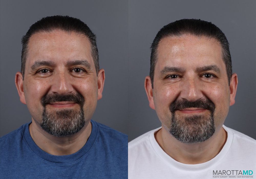 Botox - Glabella - Thumbnail 4