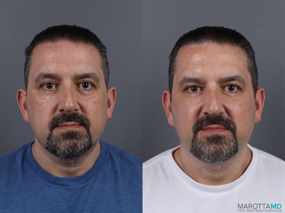 Before and after Botox - Forehead case 14120