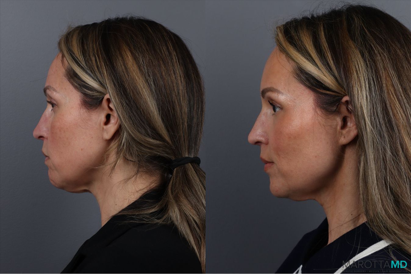 Before and after Botox - Chin case 41878 - Angle 3