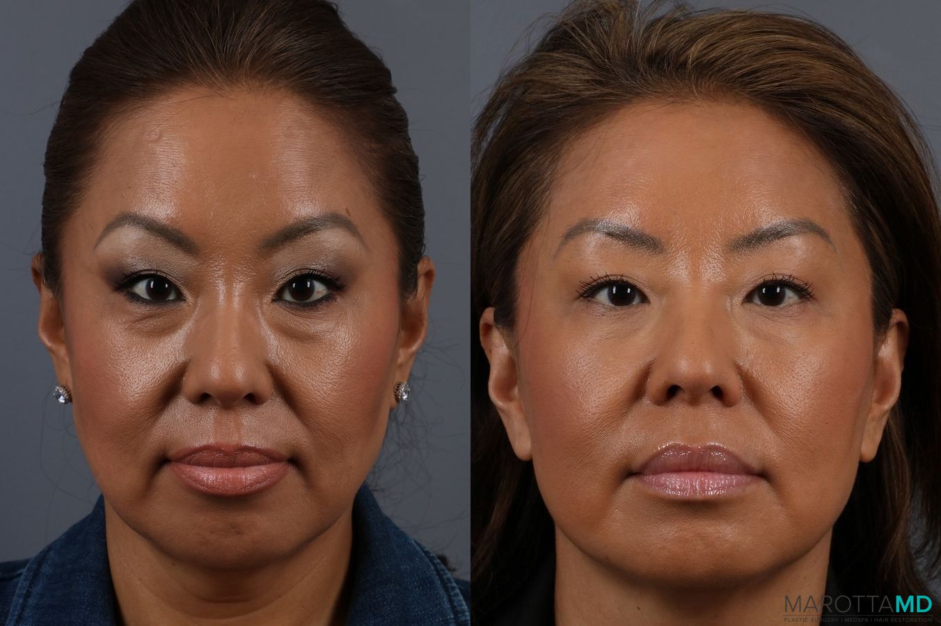 Before and after Botox - Glabella case 7143
