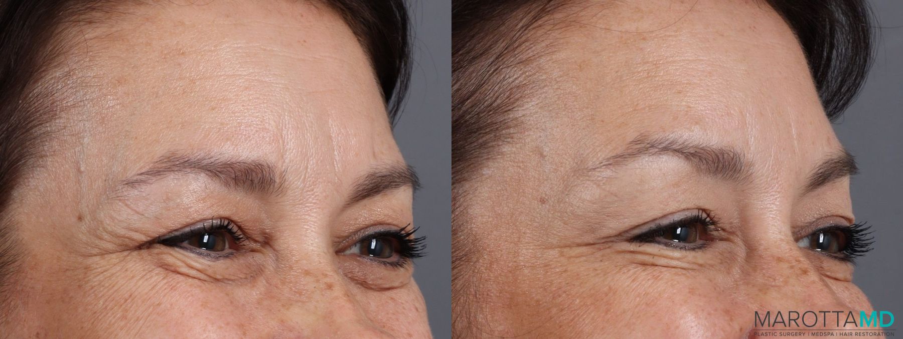 Before and after Botox - Glabella case 7182 - Angle 3