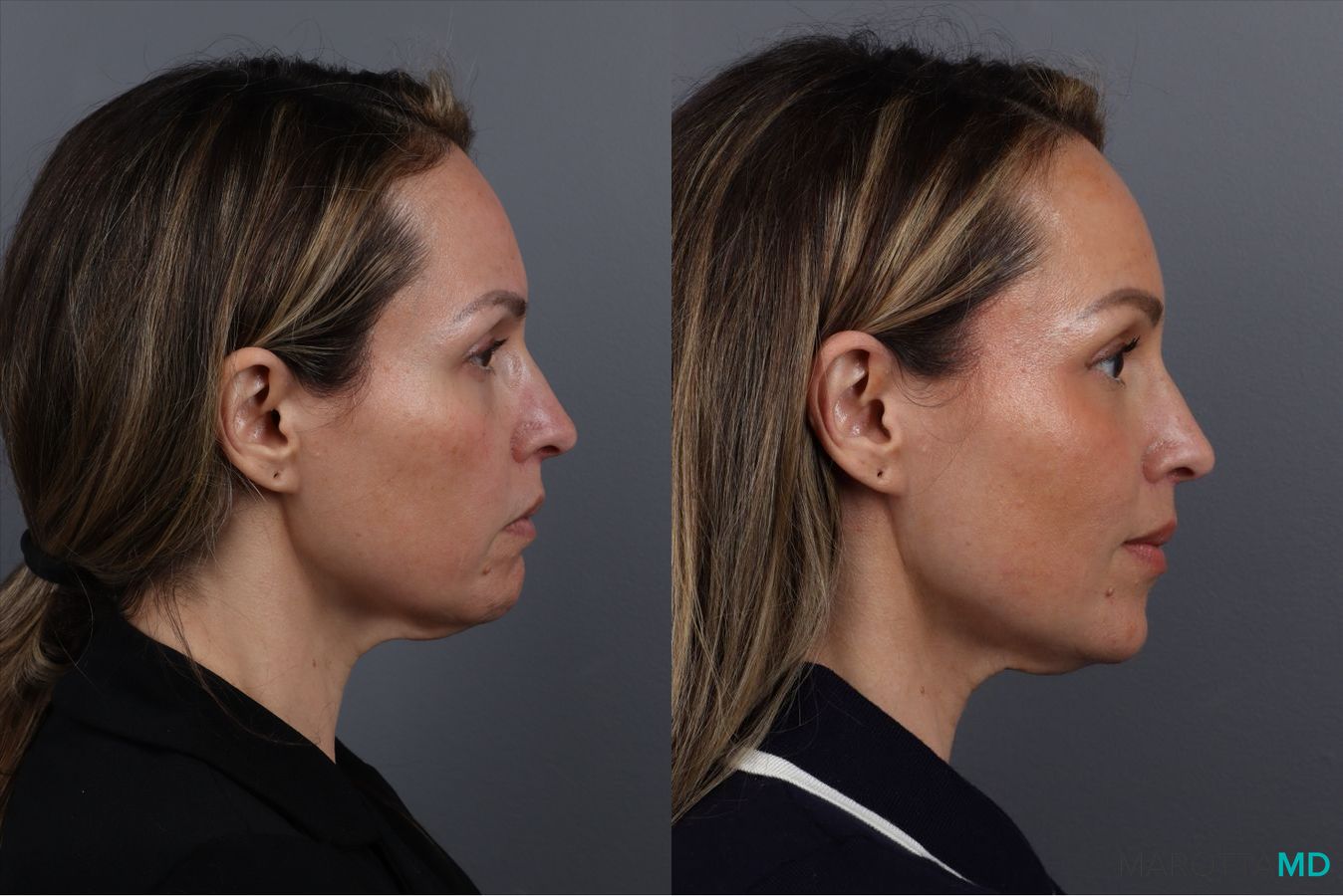 Before and after Botox - Chin case 41878 - Angle 5