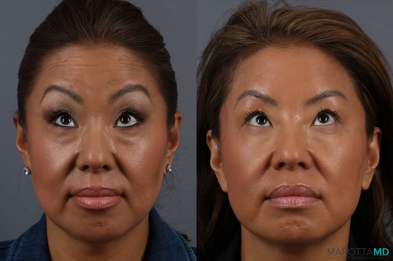 Before and after Botox - Glabella case 7143 - Angle 4