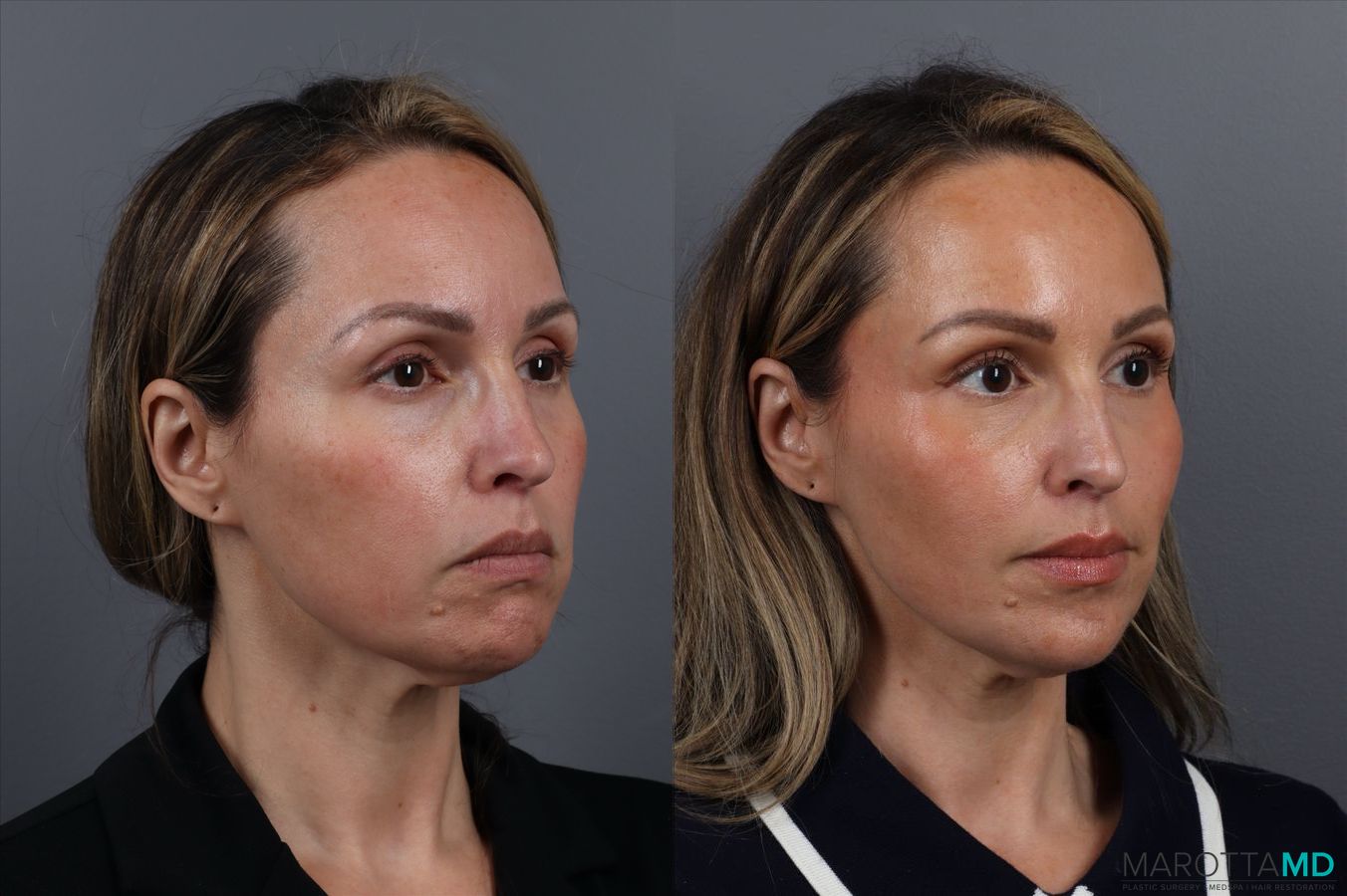 Before and after Botox - Chin case 41878 - Angle 4