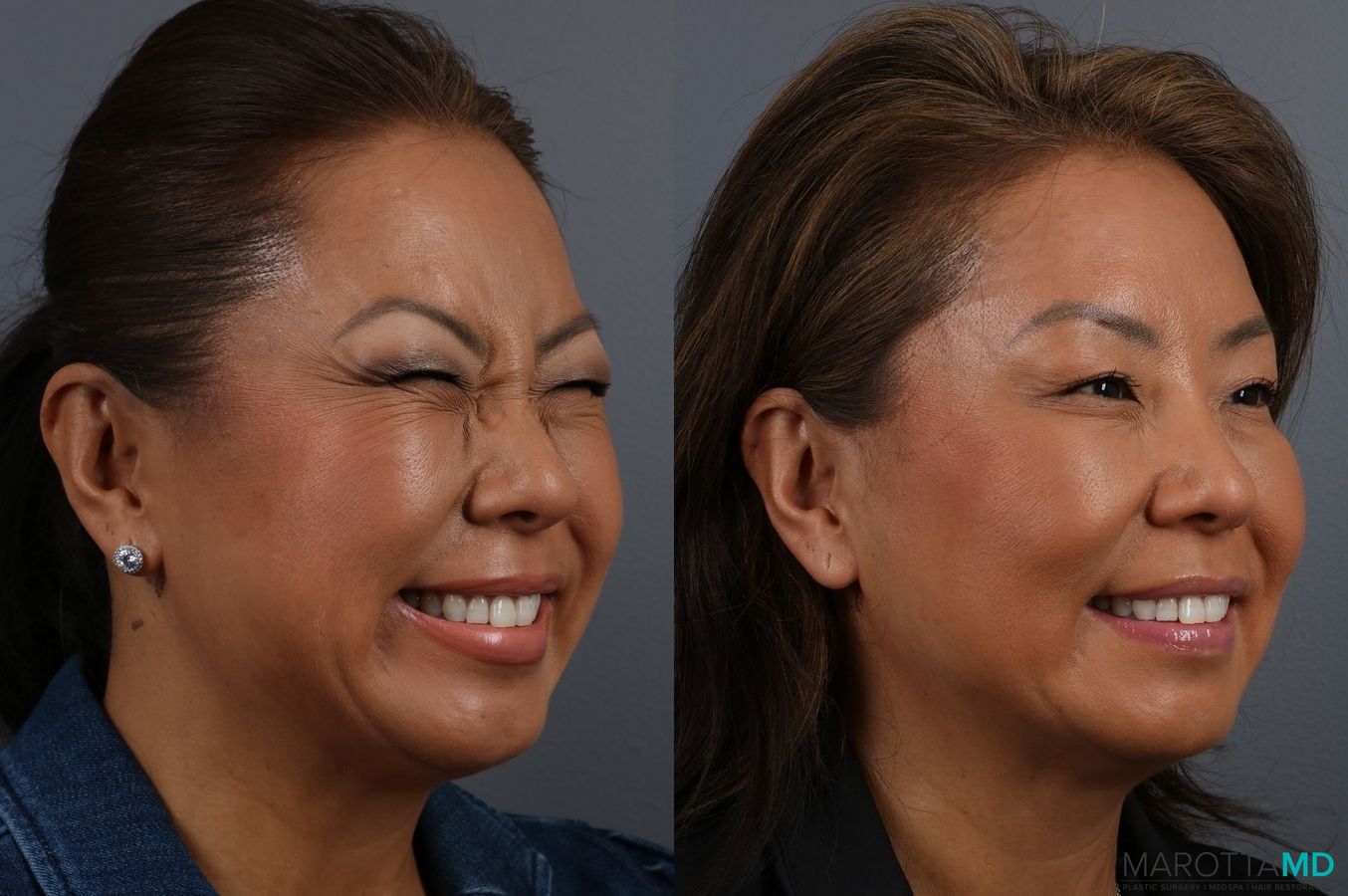 Before and after Botox - Glabella case 7143 - Angle 3