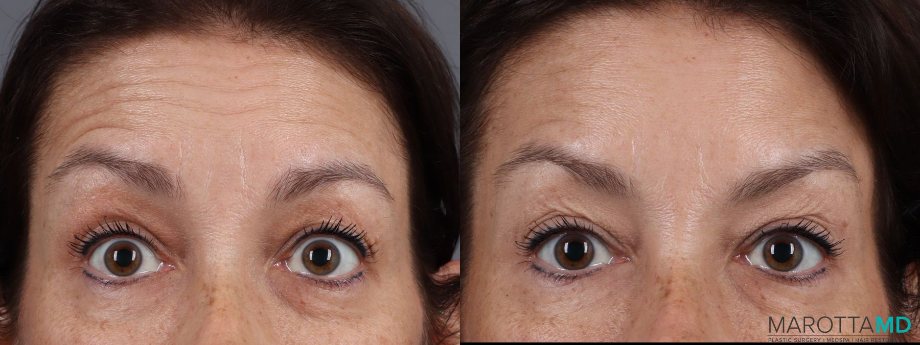 Before and after Botox - Glabella case 7182 - Angle 2