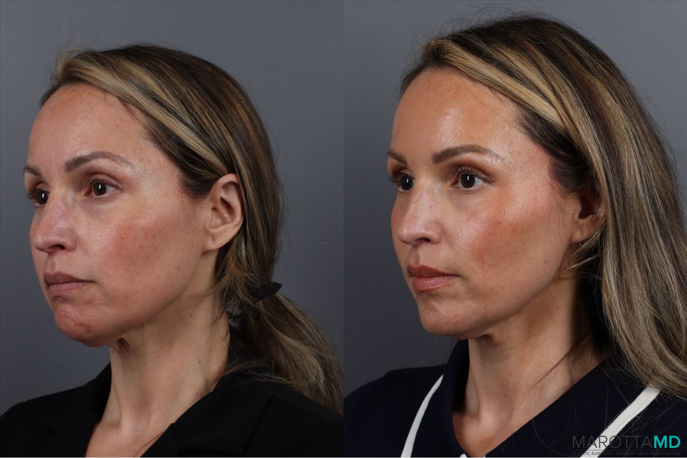 Before and after Botox - Chin case 41878 - Angle 2