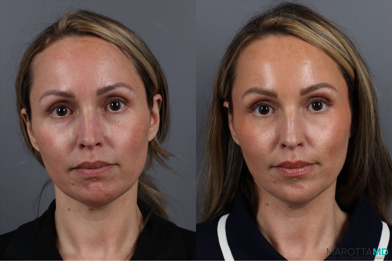Before and after Botox - Chin case 41878