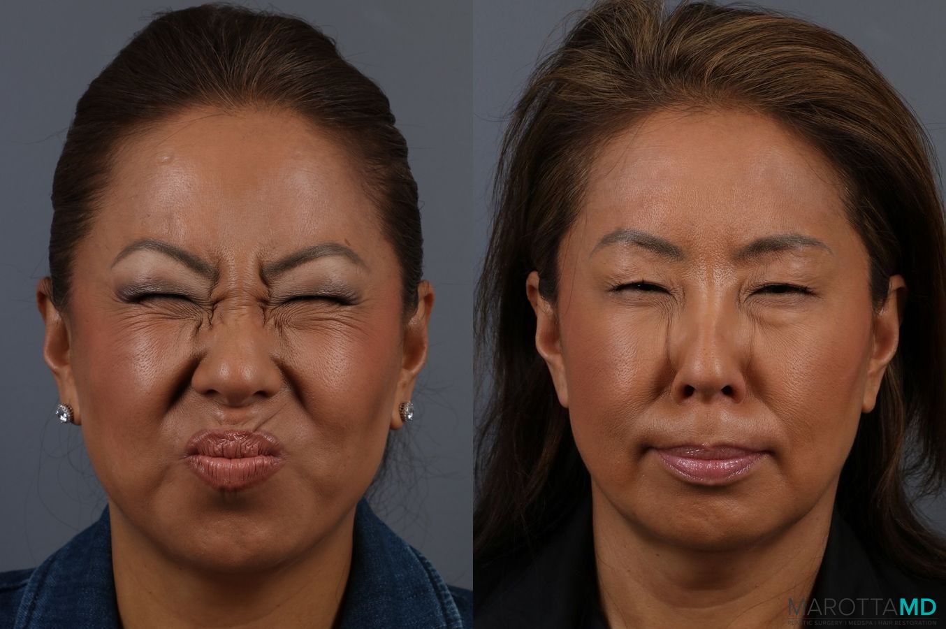 Before and after Botox - Glabella case 7143 - Angle 2