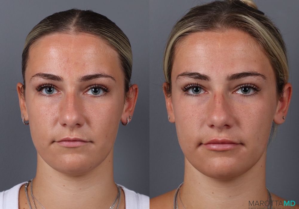 Botox - Gummy Smile - Thumbnail 2