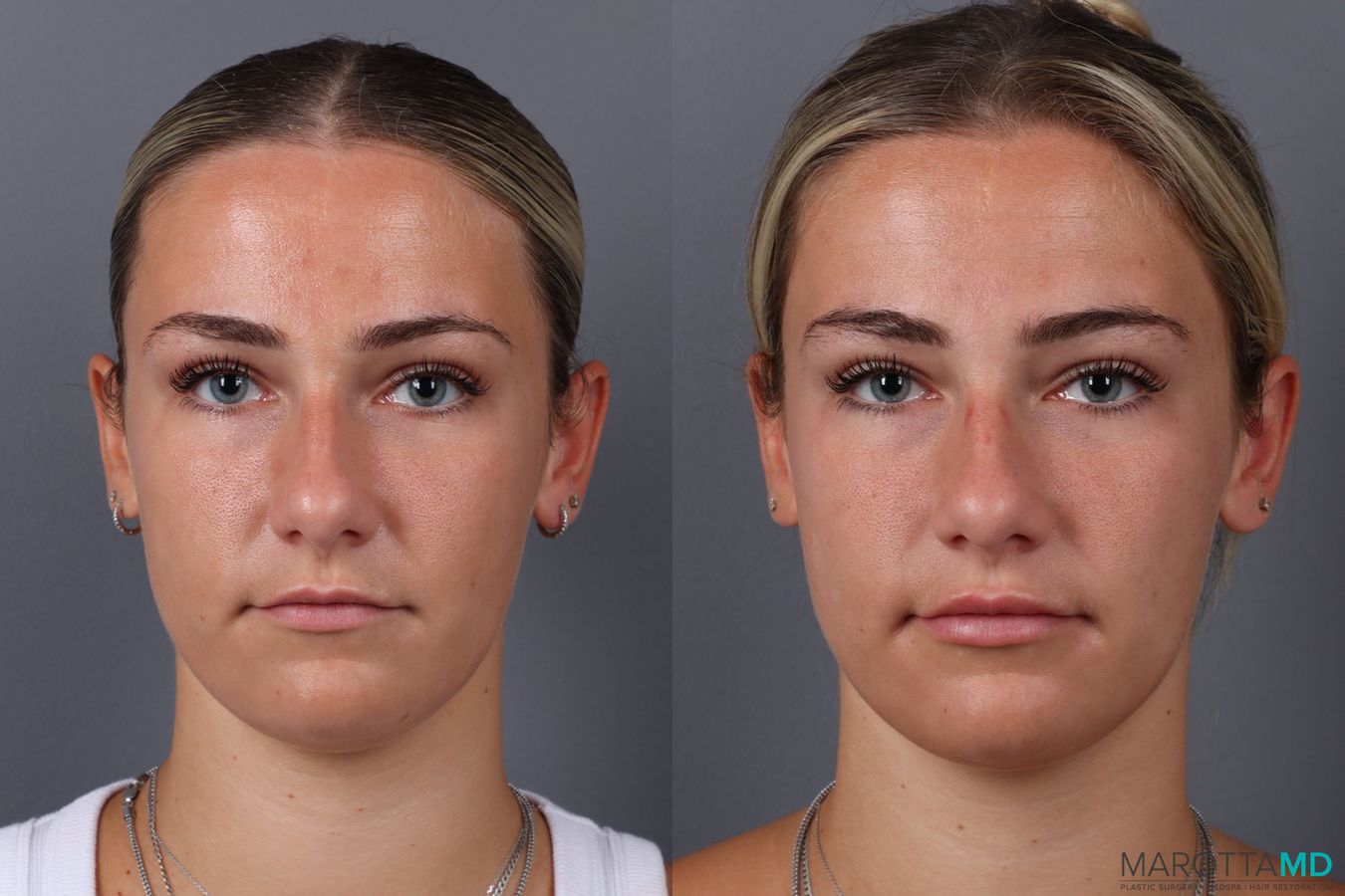 Before and after Filler - Lips case 21377 - Angle 2