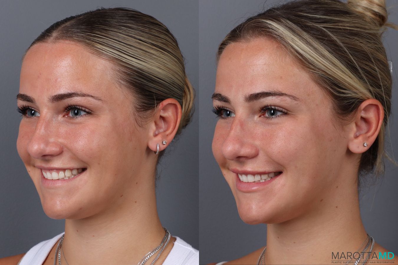 Before and after Filler - Lips case 21377 - Angle 4