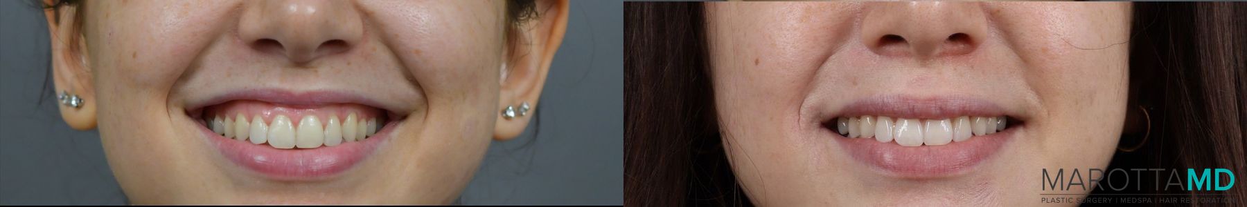 Before and after Botox - Gummy Smile case 7302