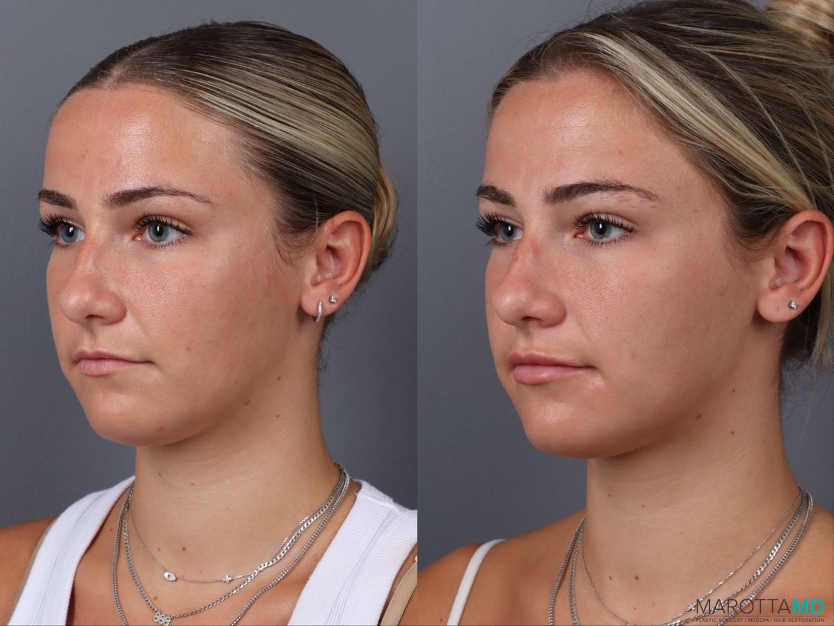 Before and after Filler - Lips case 21377 - Angle 3
