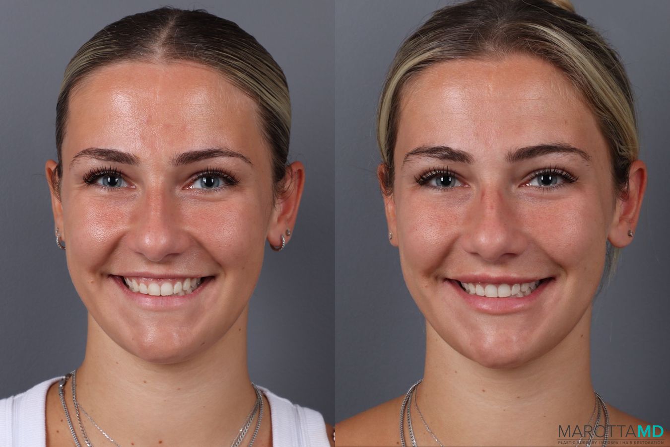 Before and after Filler - Lips case 21377