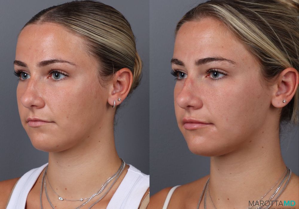 Botox - Gummy Smile - Thumbnail 3