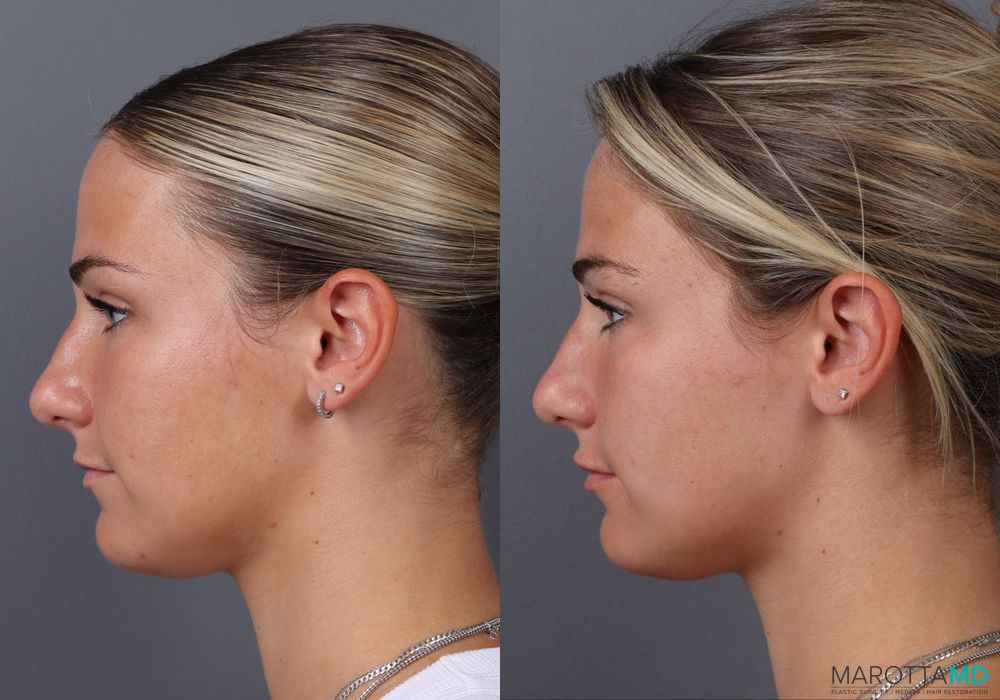 Botox - Gummy Smile - Thumbnail 5