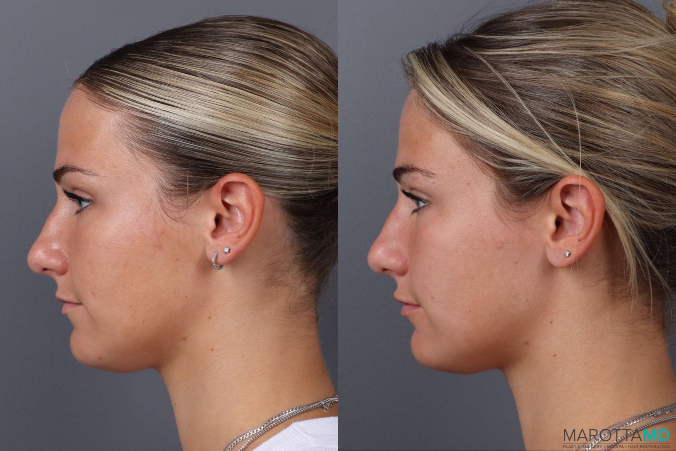 Before and after Filler - Lips case 21377 - Angle 5