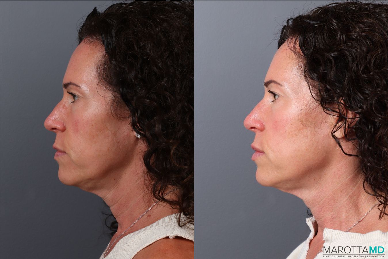 Before and after Botox - Chin case 41872 - Angle 5
