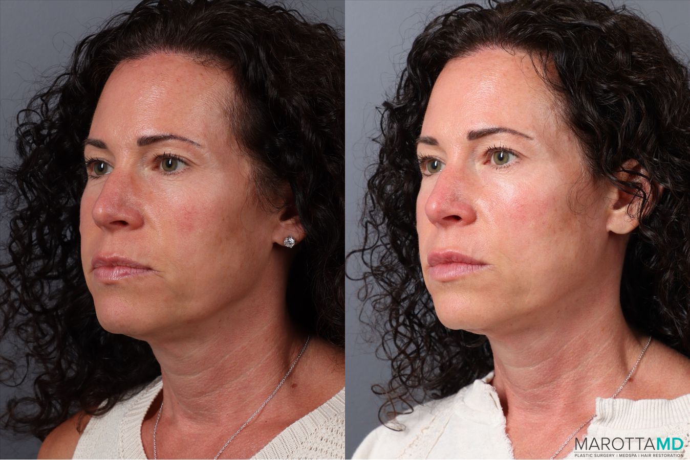 Before and after Botox - Chin case 41872 - Angle 4