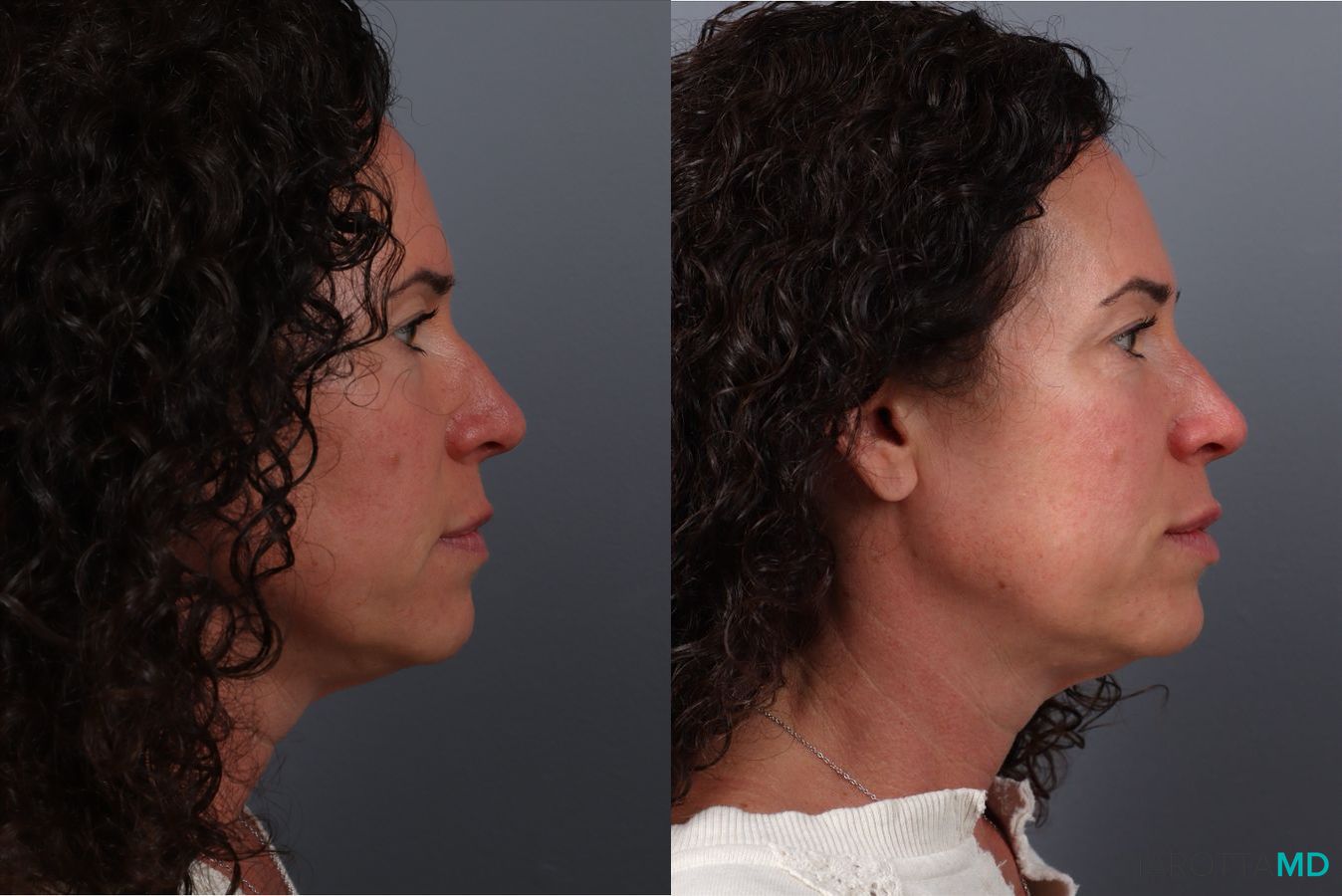 Before and after Botox - Chin case 41872 - Angle 3