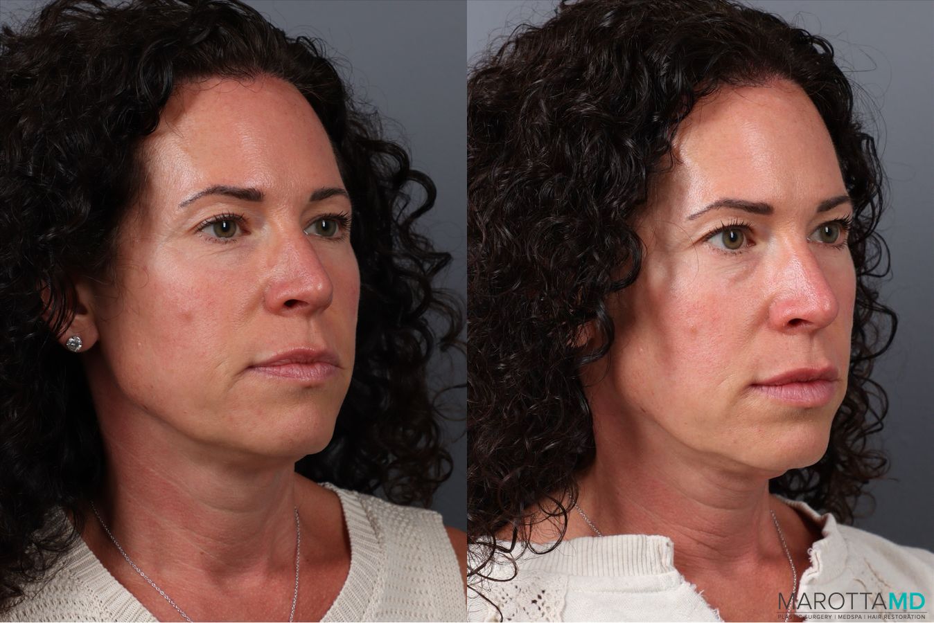 Before and after Botox - Chin case 41872 - Angle 2