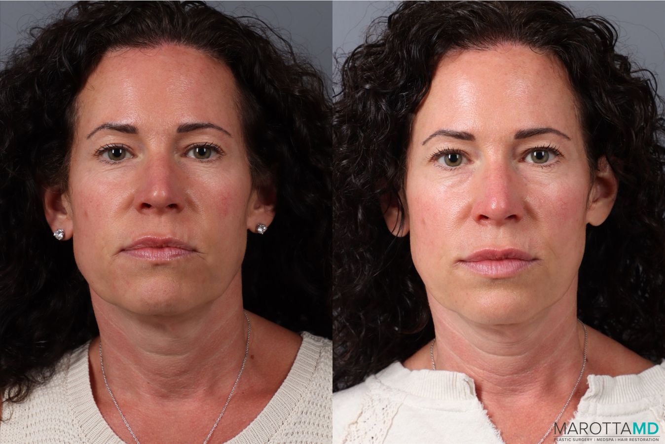 Before and after Botox - Chin case 41872