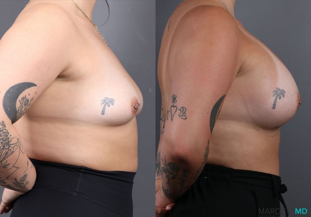 Breast Augmentation - Thumbnail 3