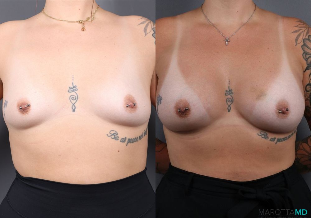 Breast Augmentation - Case 131