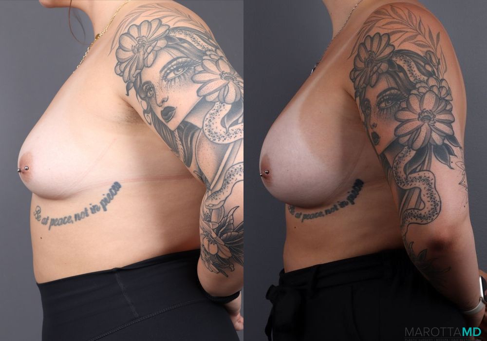 Breast Augmentation - Thumbnail 5