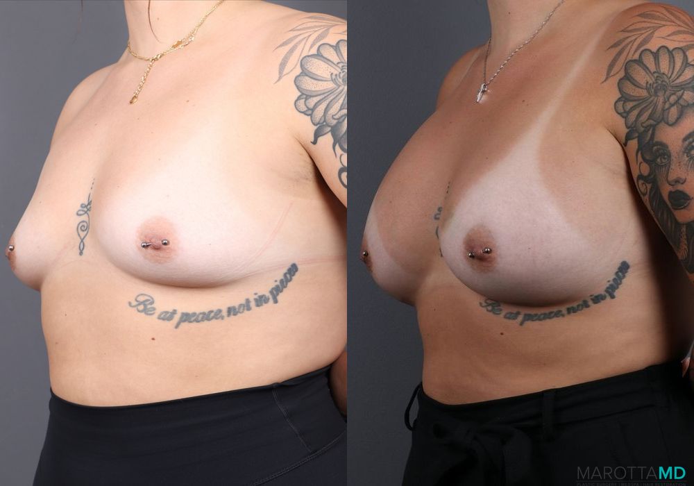 Breast Augmentation - Thumbnail 4