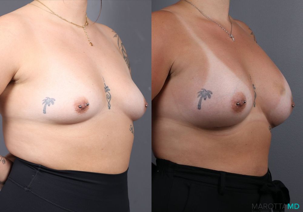 Breast Augmentation - Thumbnail 2