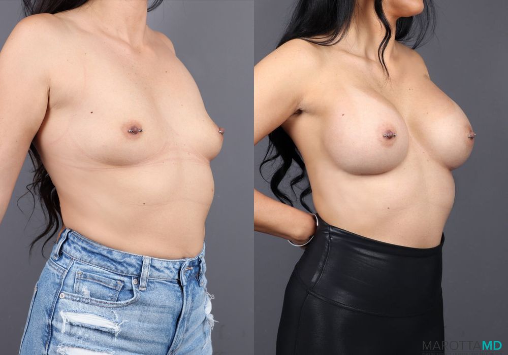 Breast Augmentation - Thumbnail 2