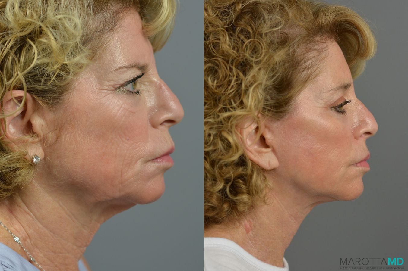 Before and after Brow Lift case 7282 - Angle 3