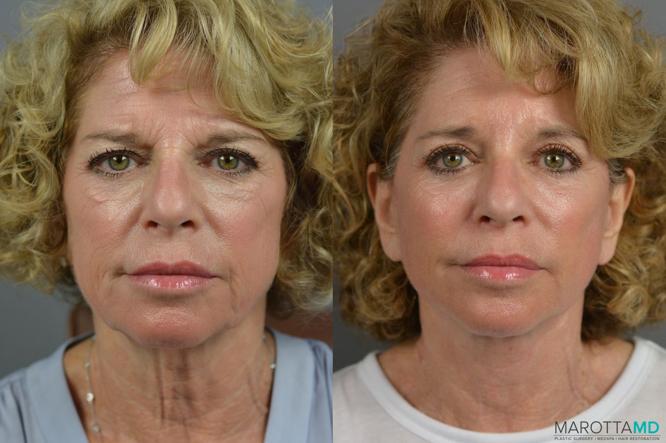 Before and after Brow Lift case 7282