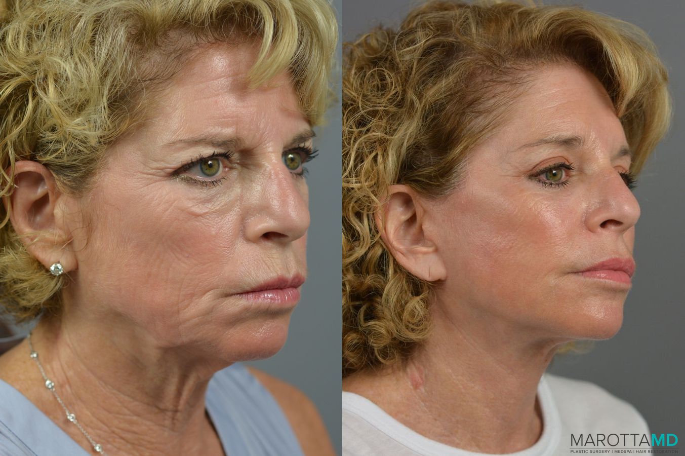 Before and after Brow Lift case 7282 - Angle 2