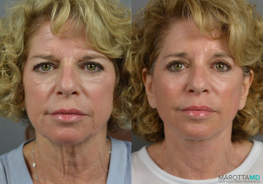 Brow Lift - Case 959