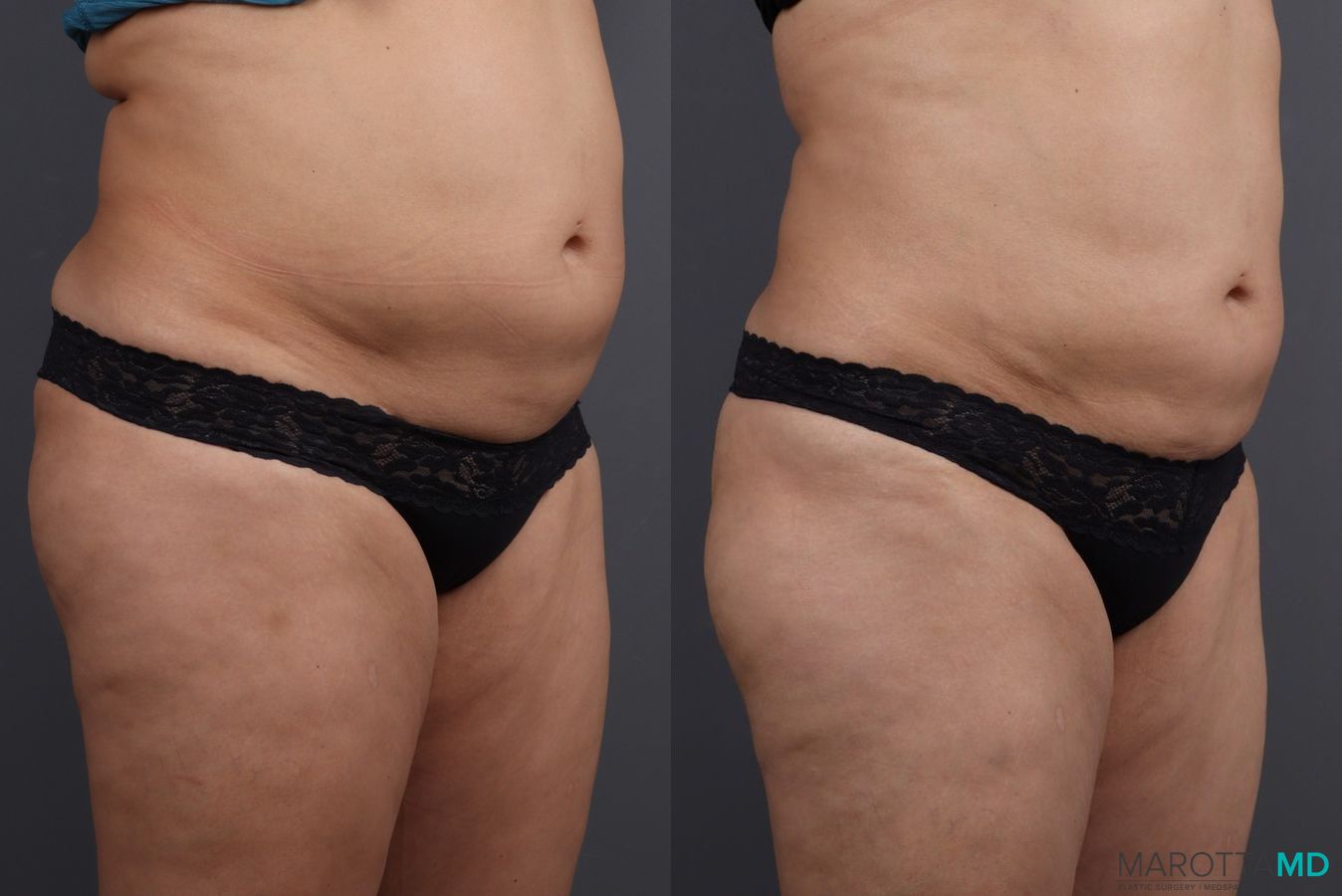 Before and after EMSCULPT® case 7247 - Angle 2